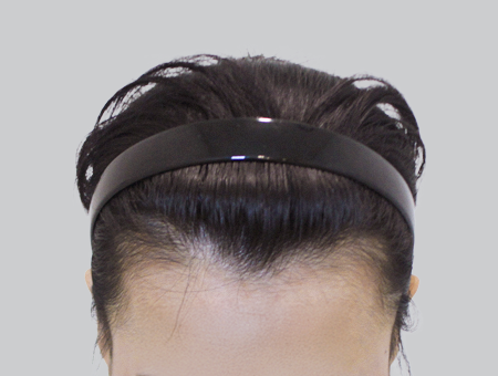 Before 女性症例 ヘアライン 2025