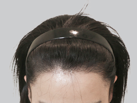 After 女性症例 ヘアライン 2025