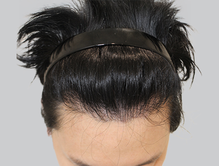 Before 女性症例 ヘアライン 2025