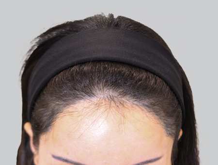 Before 女性症例 ヘアライン 2025