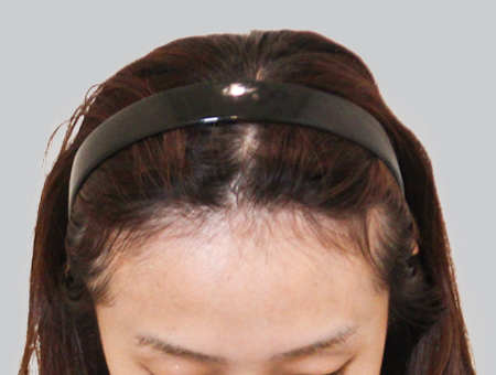 Before 女性症例 ヘアライン 2025