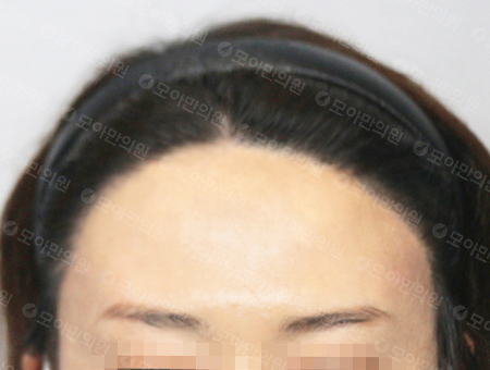 After 女性症例26 ヘアライン