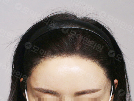 After 女性症例23 ヘアライン