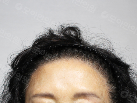 After 女性症例22 ヘアライン