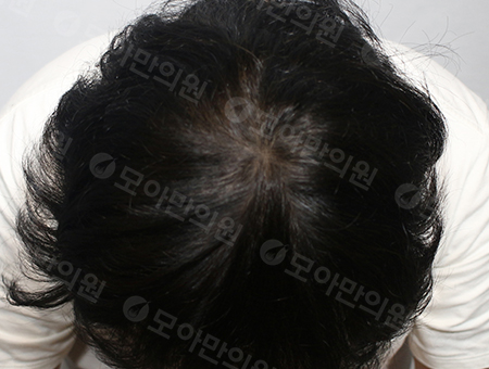 After 女性症例20 頭頂部