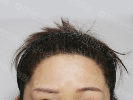 After 女性症例17 ヘアライン
