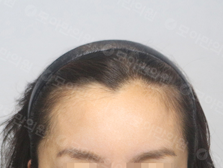 Before 女性症例06 ヘアライン