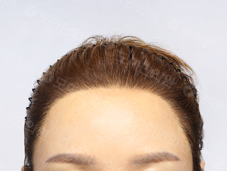 After 女性症例25 ヘアライン