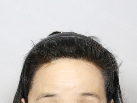 After 女性症例14 ヘアライン