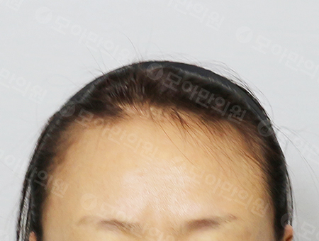 Before 女性症例12 ヘアライン