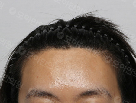 After 女性症例11 ヘアライン