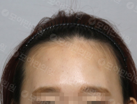 Before 女性症例10 ヘアライン