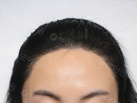 After 女性症例07 ヘアライン