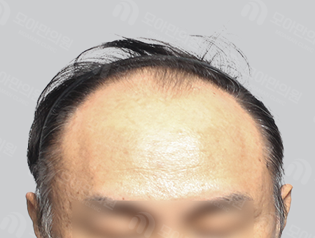 Before 男性症例 ヘアライン