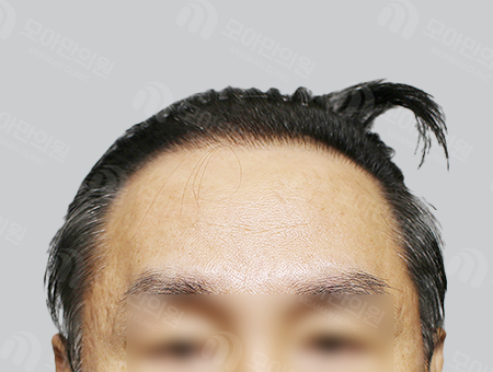 After 男性症例 ヘアライン