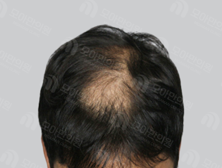 Before 男性症例 ヘアライン〜頭頂部
