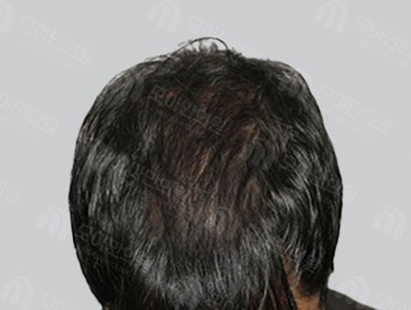 After 男性症例 ヘアライン〜頭頂部