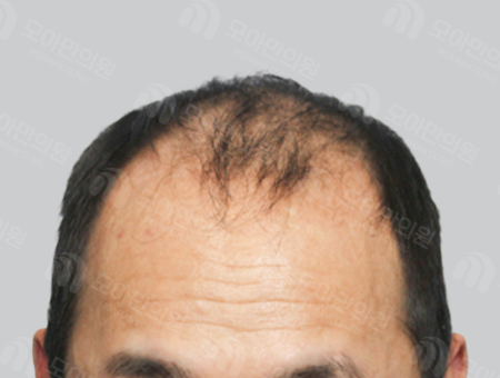Before 男性症例 M字ヘアライン