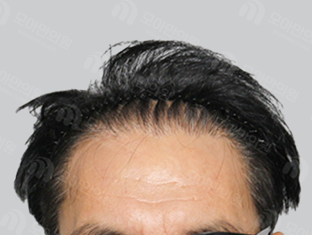After 男性症例 M字ヘアライン〜頭頂部