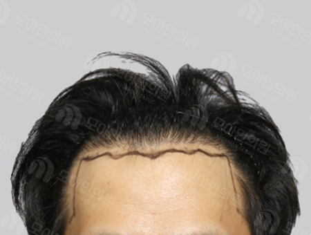 Before 男性症例 M字ヘアライン