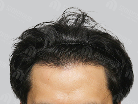 After 男性症例 M字ヘアライン