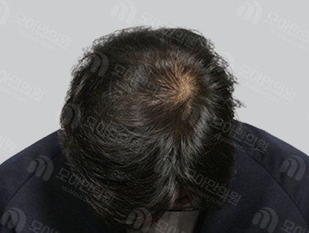 After 男性症例 頭頂部