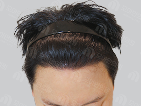 After 男性症例 M字ヘアライン