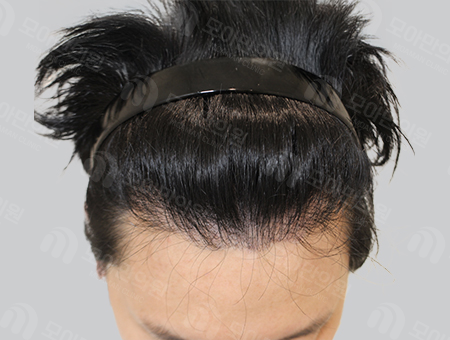 Before 男性症例 M字ヘアライン