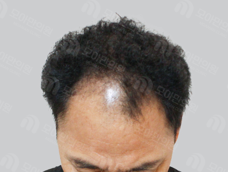 Before 男性症例 ヘアライン〜中頭部